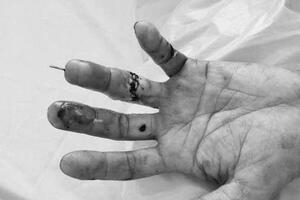 Nối thành công ngón tay đứt lìa cho bệnh nhân 47 tuổi tại Bệnh viện Đa khoa Trà Vinh