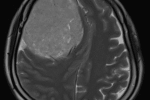 KHOA NGOẠI THẦN KINH PHẪU THUẬT THÀNH CÔNG KHỐI U MÀNG NÃO KÍCH THƯỚC LỚN