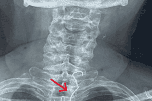 Lấy thành công hàm răng giả mắc kẹt trong thực quản bệnh nhân 61 tuổi