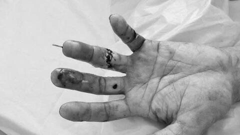 Nối thành công ngón tay đứt lìa cho bệnh nhân 47 tuổi tại Bệnh viện Đa khoa Trà Vinh