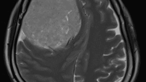 KHOA NGOẠI THẦN KINH PHẪU THUẬT THÀNH CÔNG KHỐI U MÀNG NÃO KÍCH THƯỚC LỚN