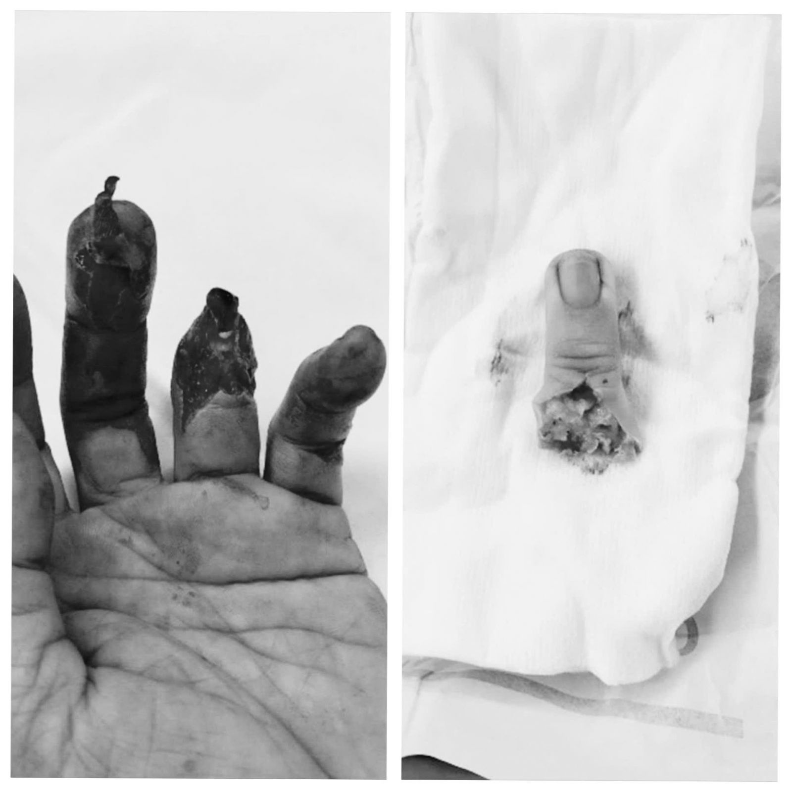 Hiện trạng bàn tay và ngón tay đứt rời của bệnh nhân trước khi phẫu thuật